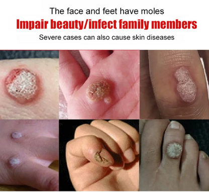 Wart Remover Gel